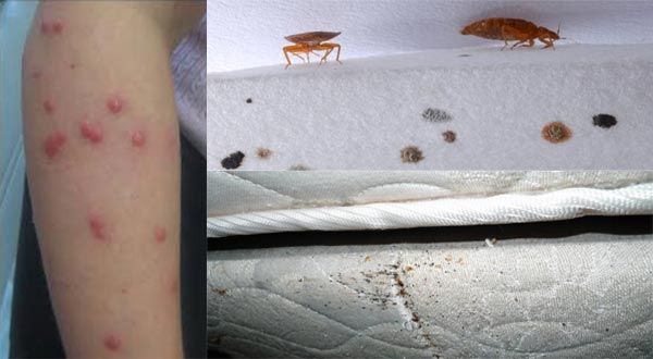لدغات بق الفراش